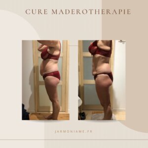 Cure madérothérapie avant/après